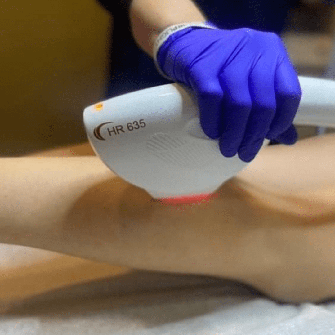 IPL Hair Removal